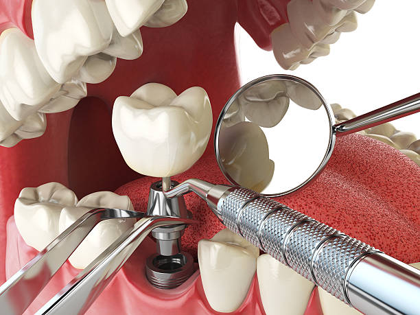 Best Emergency Wisdom Tooth Extraction in Green River, WY
